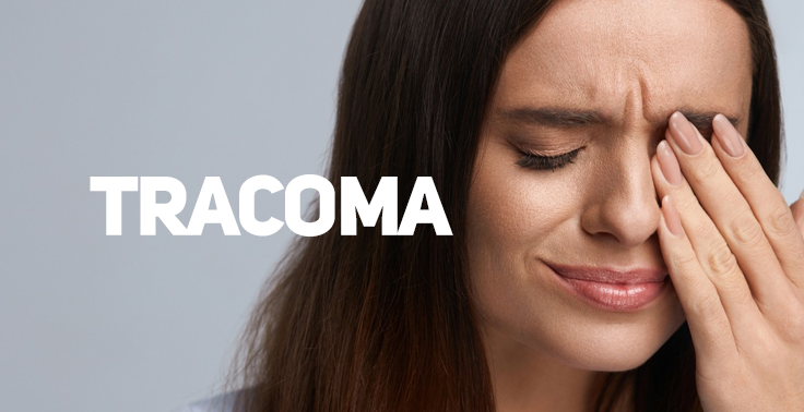 Imagem com fundo claro contendo o texto TRACOMA em letras maiúsculas na cor branca, posicionado no lado esquerdo. No lado direito, em primeiro plano, vê-se o rosto de uma mulher com cabelos castanhos longos, de olhos fechados e expressão de desconforto. Ela está com os dedos da mão esquerda pressionando o olho esquerdo, sugerindo dor ou incômodo ocular.