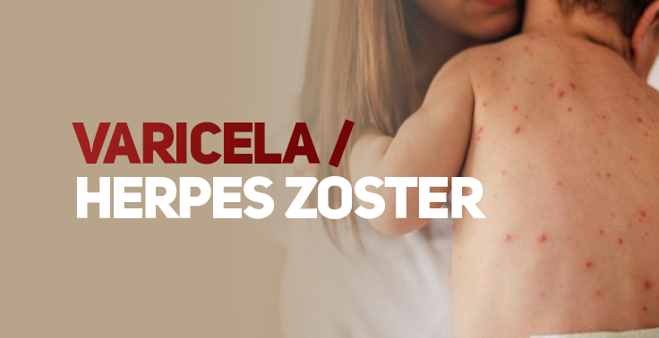 Imagem com fundo claro contendo o texto VARICELA / HERPES ZOSTER em letras maiúsculas no lado esquerdo, distribuído em duas linhas. A palavra VARICELA / está em tom vermelho-escuro e as palavras HERPES ZOSTER na cor branca. No lado direito, em primeiro plano, uma criança sem camisa é segurada no colo por um adulto. A criança está de costas para a câmera, exibindo diversas lesões avermelhadas (pápulas/vesículas características) espalhadas pela pele do tronco e braço.