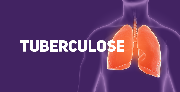 Imagem com fundo roxo contendo o texto TUBERCULOSE em letras maiúsculas e na cor branca, posicionado no lado esquerdo. No lado direito, há uma ilustração anatômica tridimensional da parte superior do tronco de uma pessoa, destacando a traqueia e os dois pulmões em tom laranja brilhante dentro da silhueta translúcida do corpo.