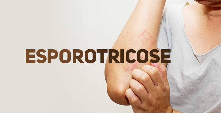 Imagem informativa de saúde com a palavra ESPOROTRICOSE em letras maiúsculas castanhas no lado esquerdo. À direita, uma pessoa de camiseta cinza segura e coça a dobra do cotovelo, onde há lesões e manchas avermelhadas na pele.